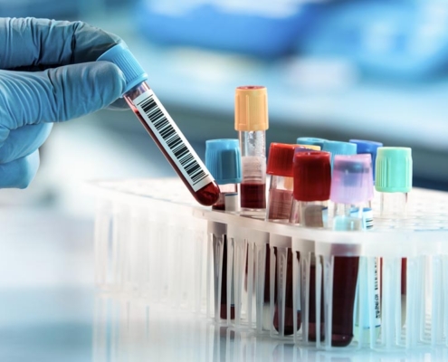 post finasteride syndrome blood test