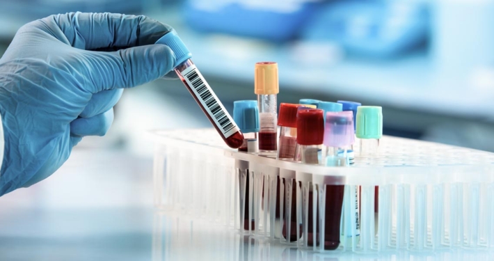 post finasteride syndrome blood test